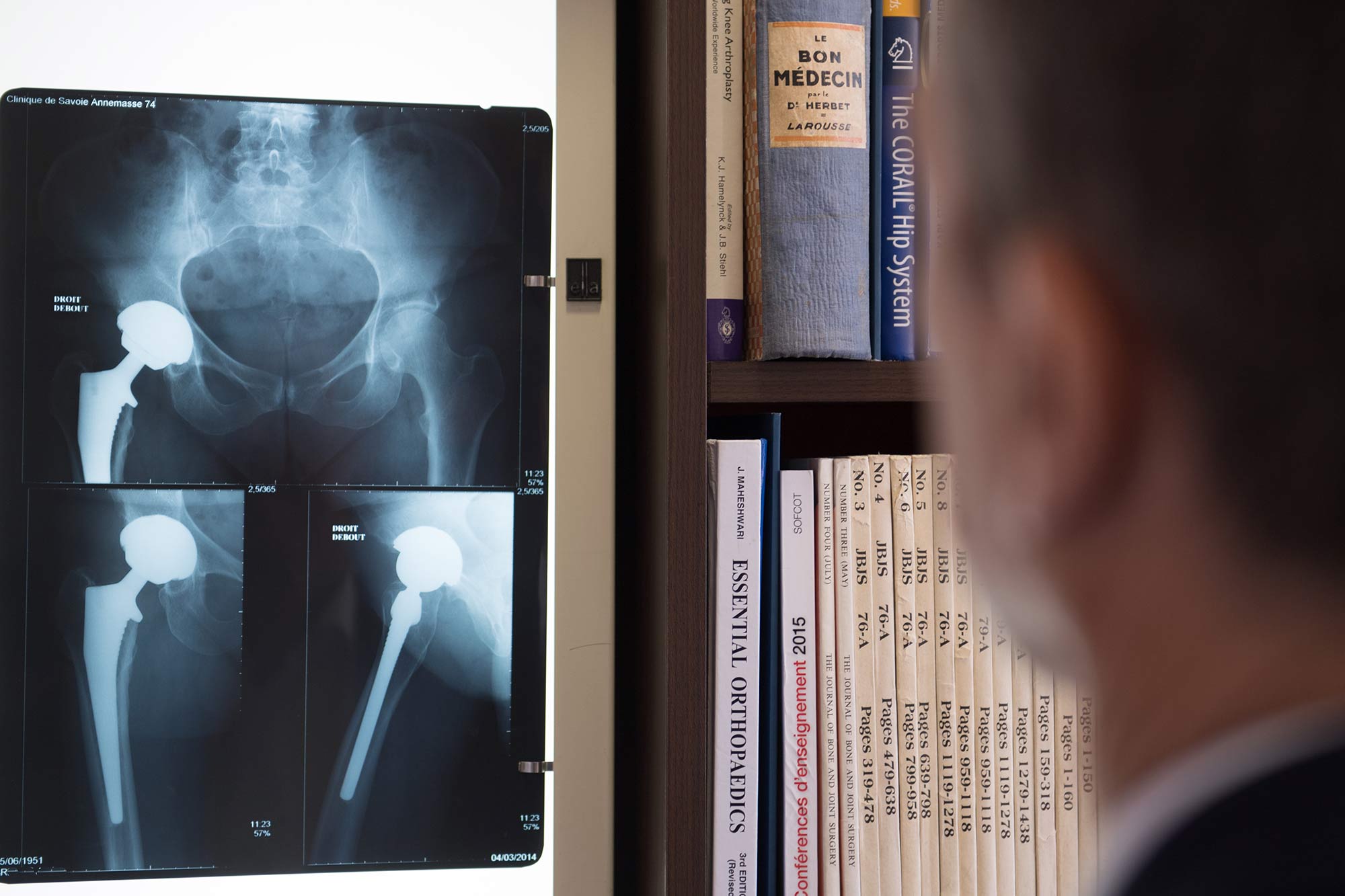 Radiographie de proth&egrave;se de hanche analys&eacute;e lors d&rsquo;une consultation m&eacute;dicale