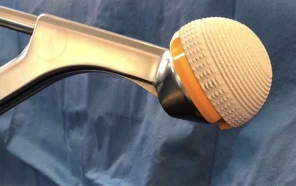 Implant orthop&eacute;dique positionn&eacute; sur un instrument chirurgical.