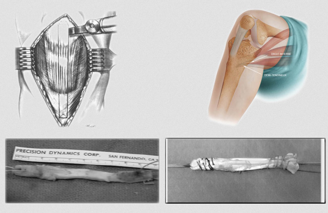 Chirurgie des ligaments croisés du Genou - Ortholac