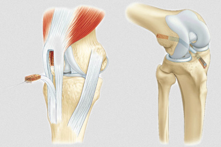 Chirurgie des ligaments croisés du Genou - Ortholac